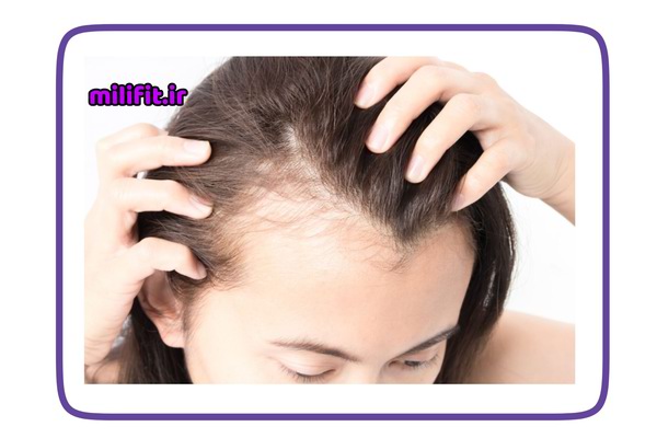ریزش موی هورمونی و ریزش موی ارثی