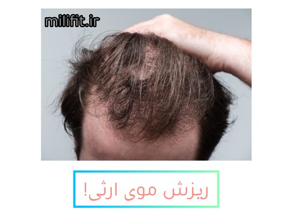 ریزش موی ارثی