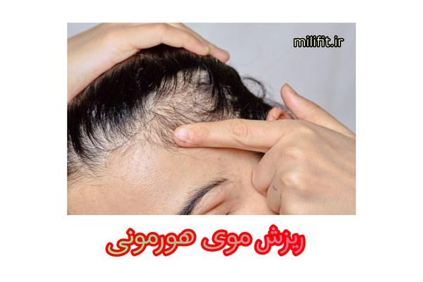 ریزش موی هورمونی