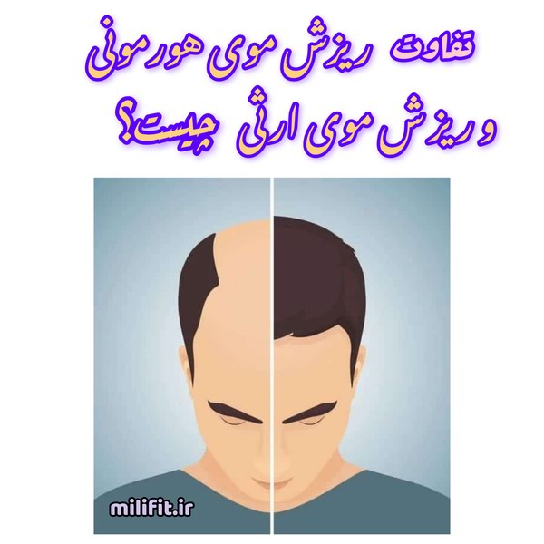 تفاوت ریزش موی هورمونی و ریزش موی ارثی چیست؟