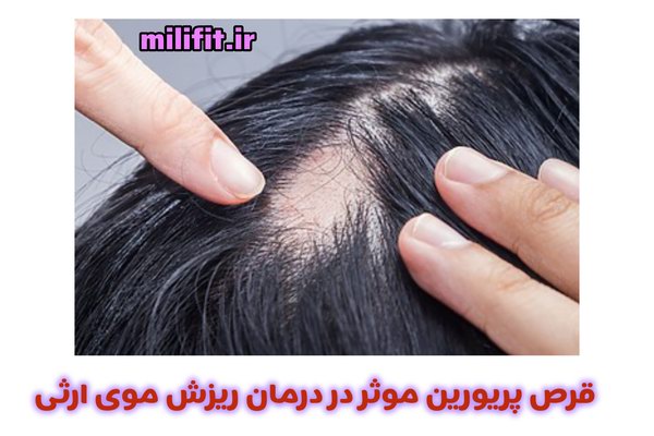 درمان ریزش موی ارثی با قرص پریورین