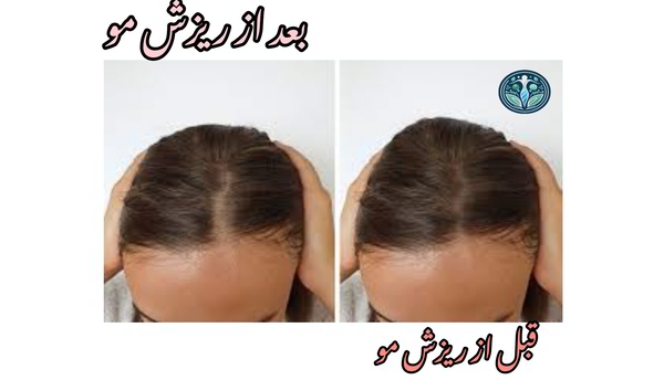 قبل و بعد از ریزش مو